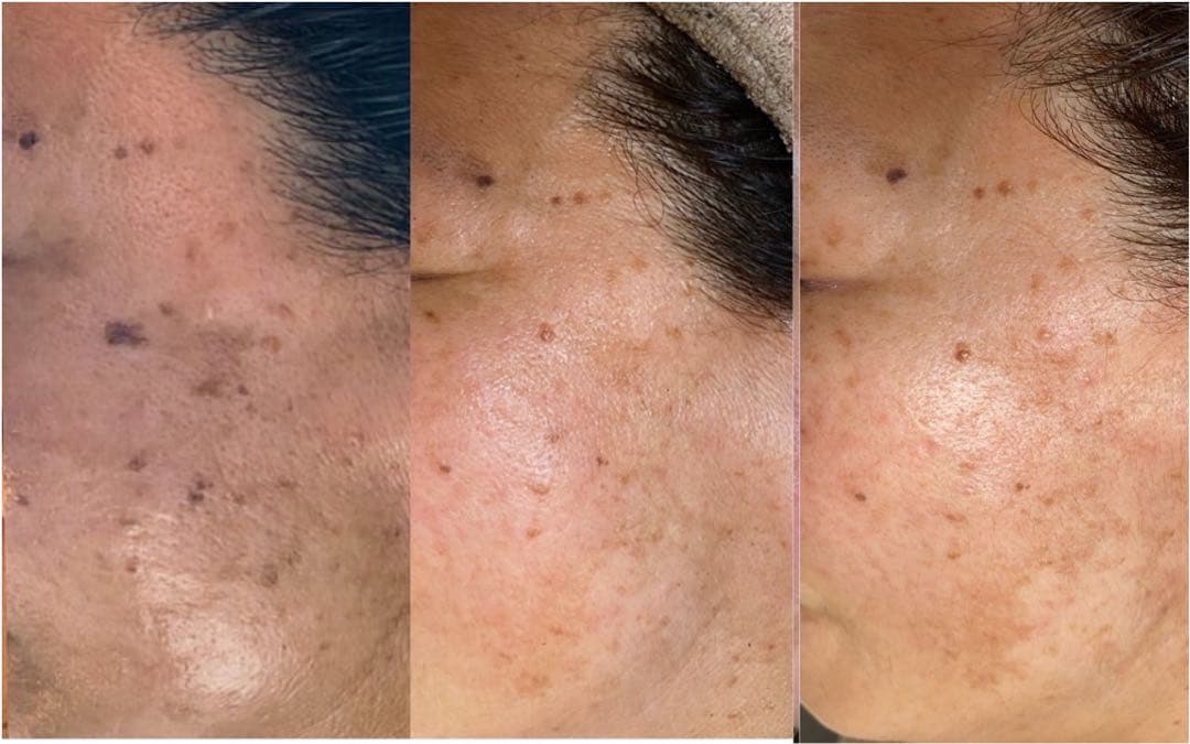 低周波ペンシル　シミケア機　リシルク　ReSilk セット販売