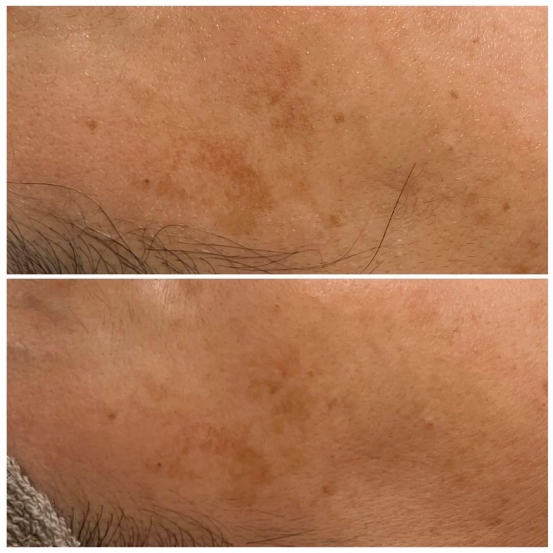 低周波ペンシル　シミケア機　リシルク　ReSilk セット販売