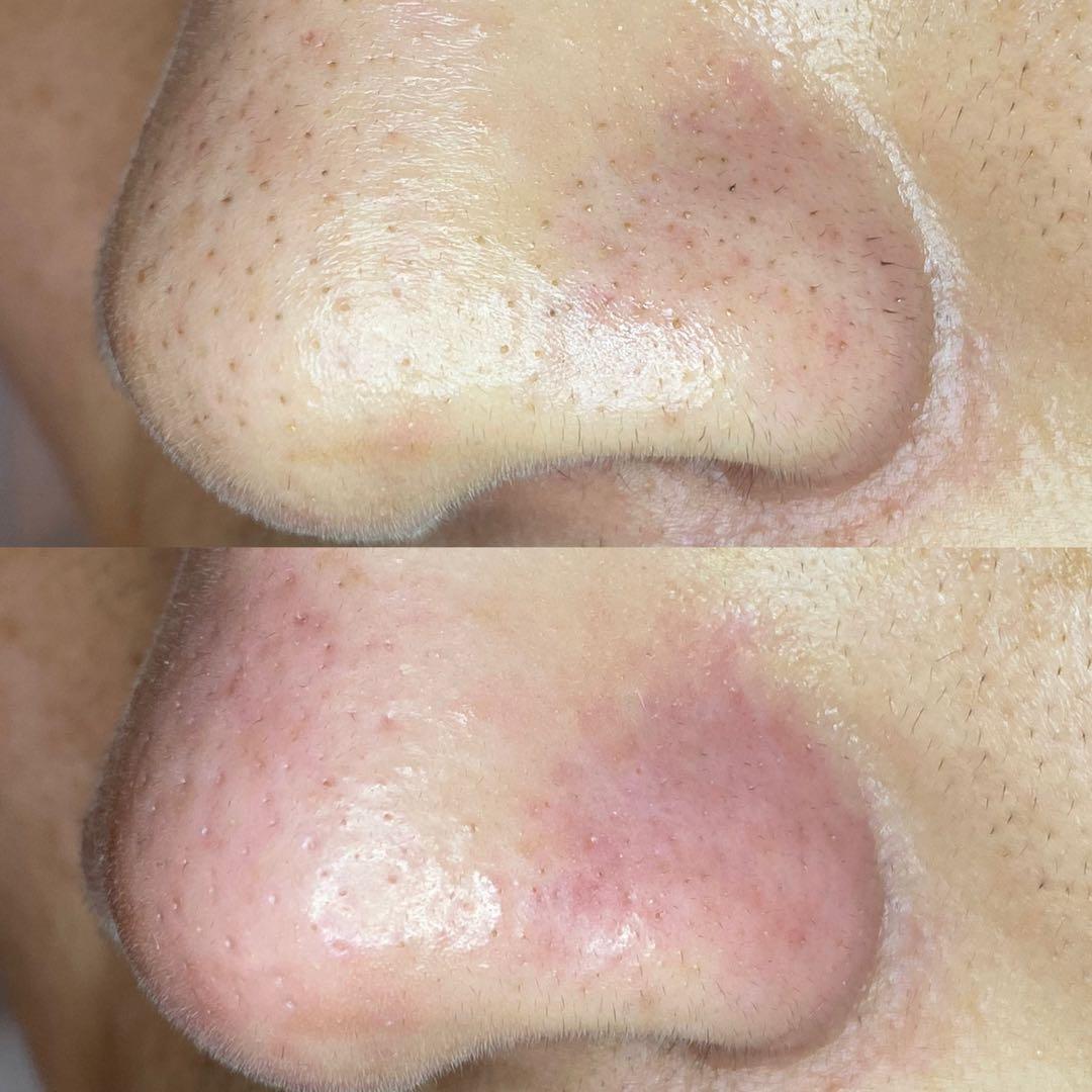 業務用毛穴洗浄ハイドラフェイシャル