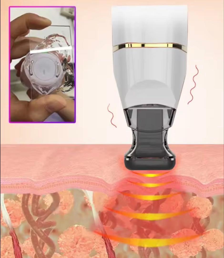 次世代リフトアップ　◽︎ サーマルフラクショナル ◽︎ フラクショナルRF