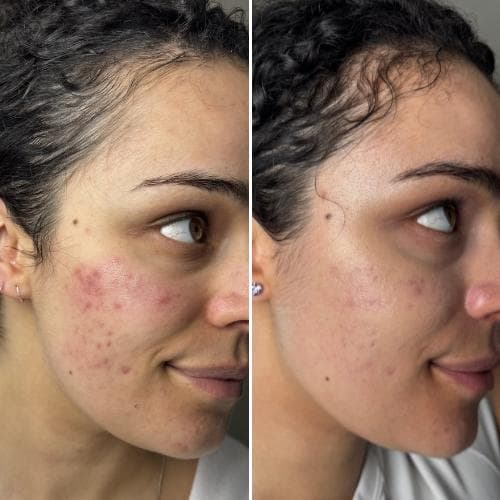 LEDライトセラピーマスク シリーズ2