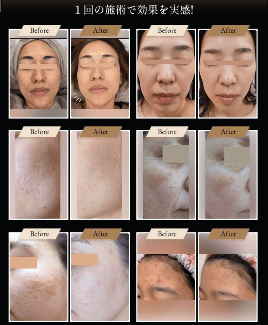 早い者勝ち！値下げ！ほぼ新品ナノスキンニードル/水光ジェット/エステ版ポテンツァ