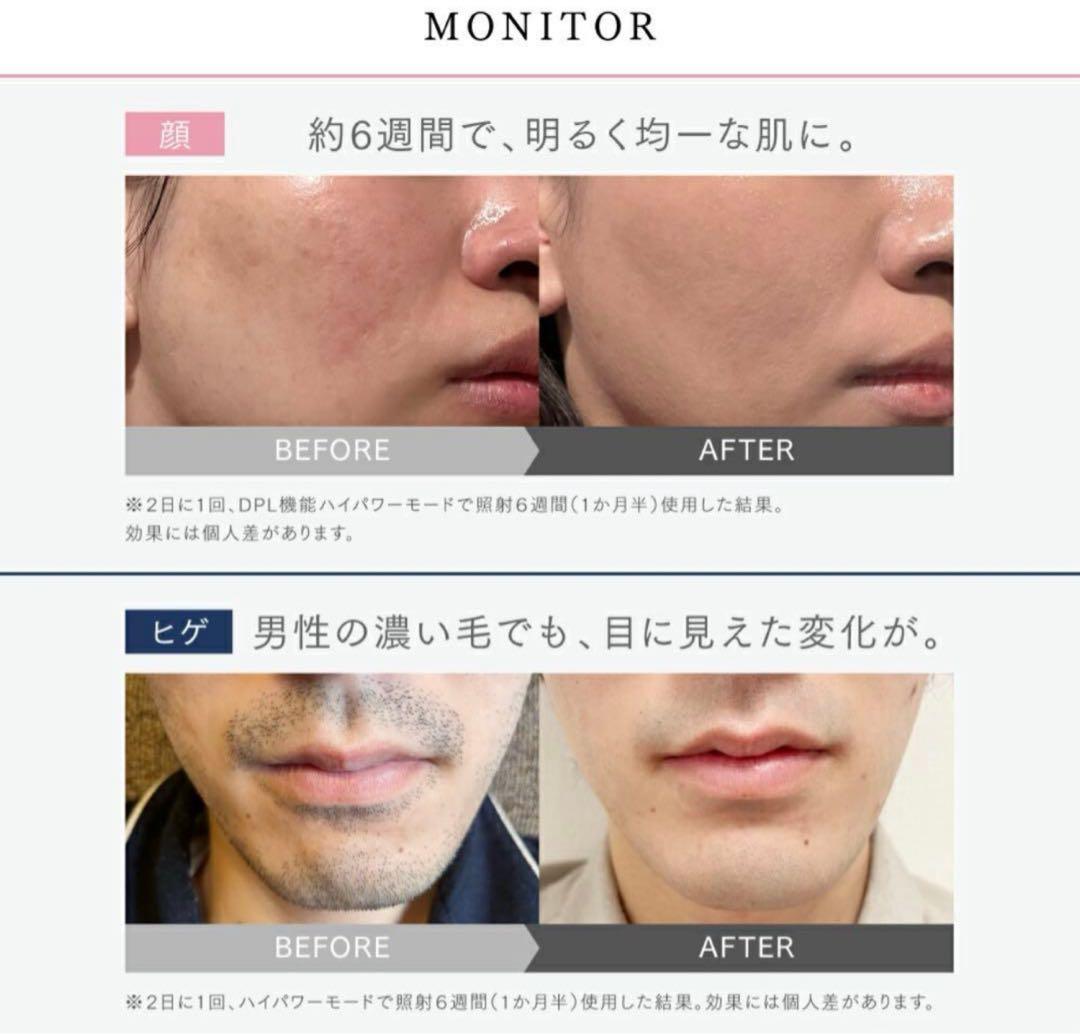 新年セール！【新品未開封】MYTREX MIRAY 美顔器 DPL IPL